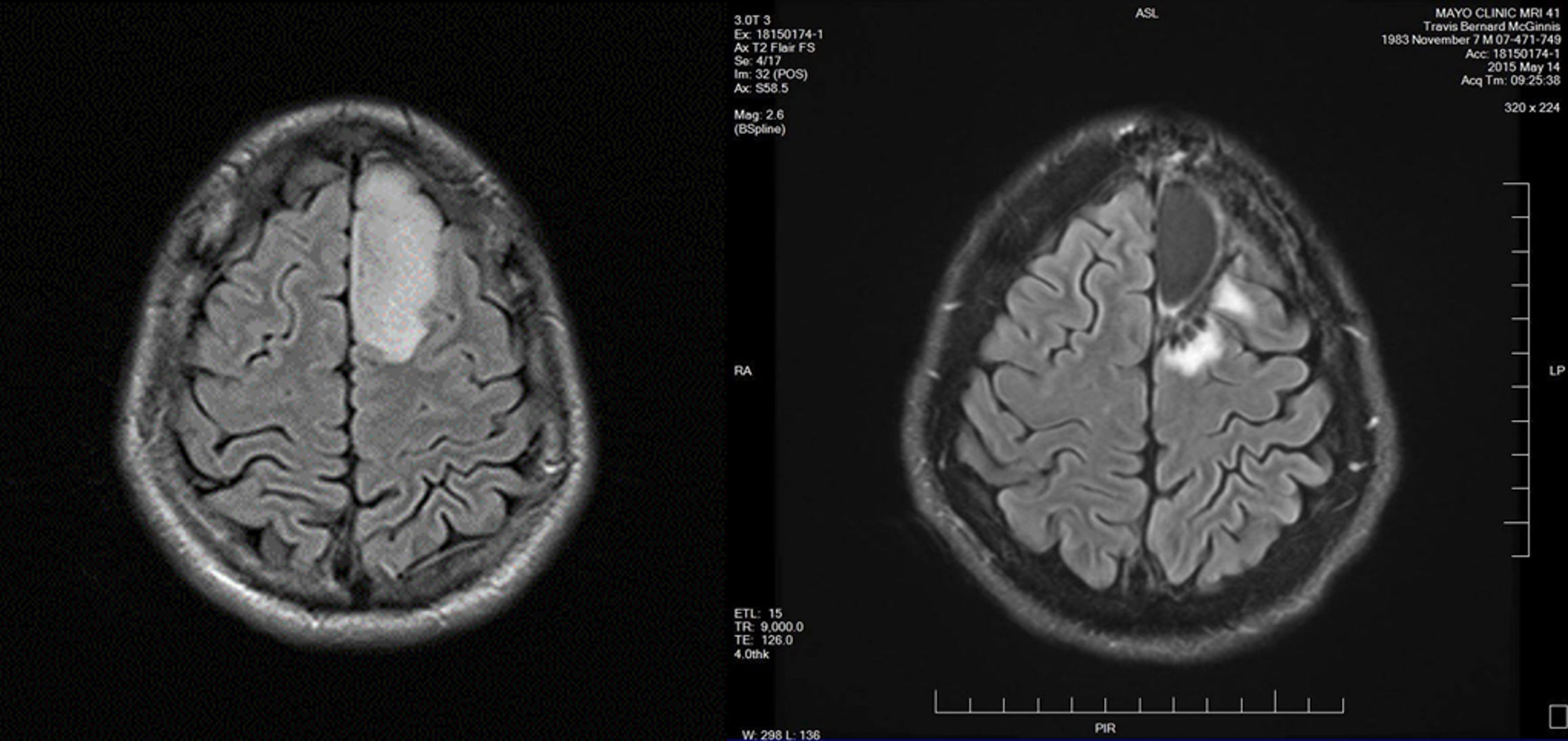How A FistSized Tumor Led to Speaking at Inbound 2019