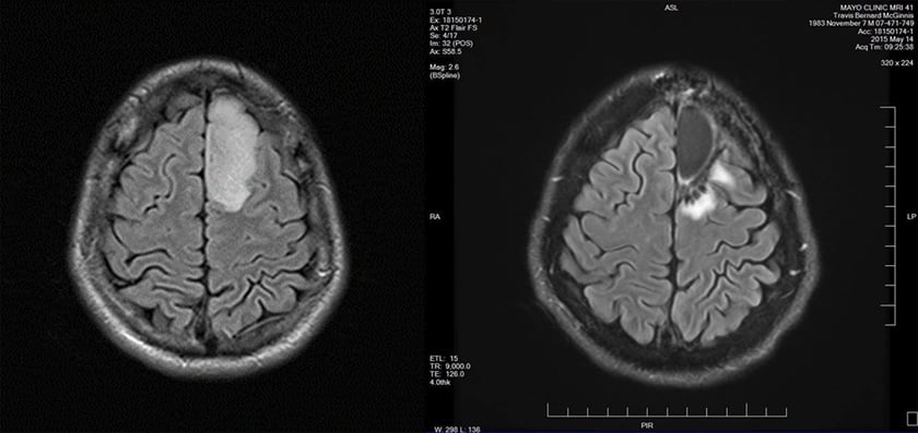 Travis' Tumor, Before & After Surgery